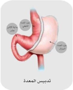 تدبيس المعدة