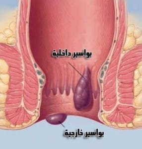 ما-هي-البواسير
