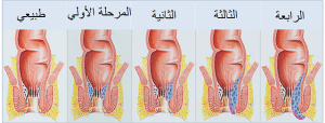 البواسير و الجماع