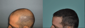 زراعة الشعر في السعودية