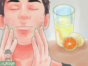 علاج آثار حب الشباب