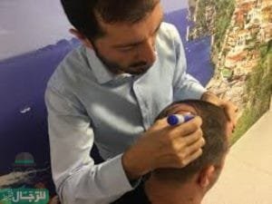 عمليات زراعة الشعر في قطر