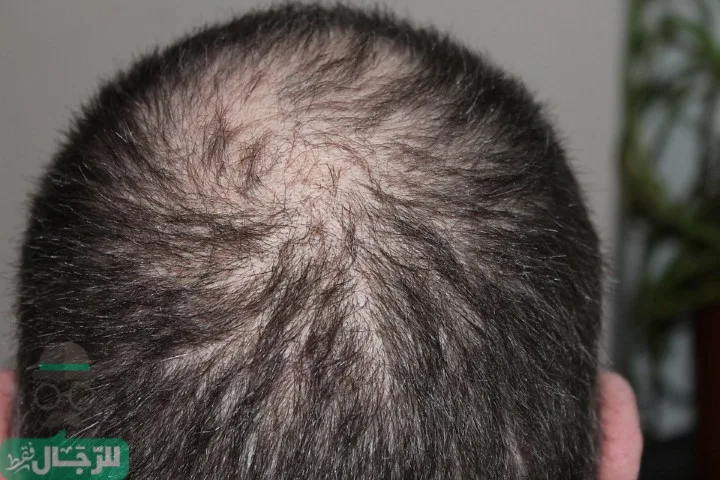 زراعة الشعر في الرياض
